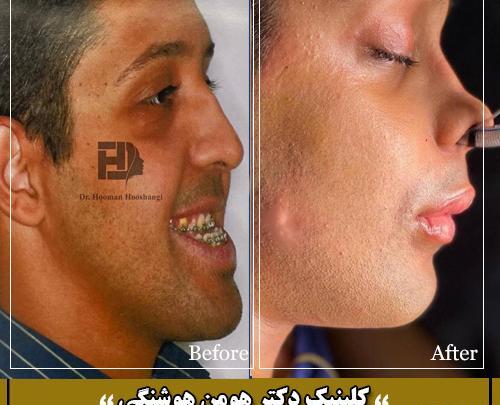 عکس قبل و بعد جراحی فک بالا