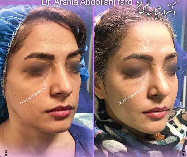 عکس قبل و بعد جراحی فک بالا