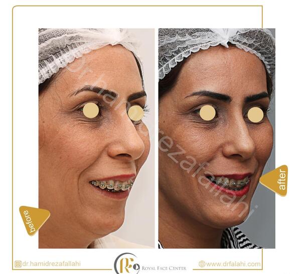 عکس قبل و بعد جراحی فک بالا