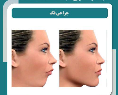 عکس قبل و بعد جراحی فک بالا