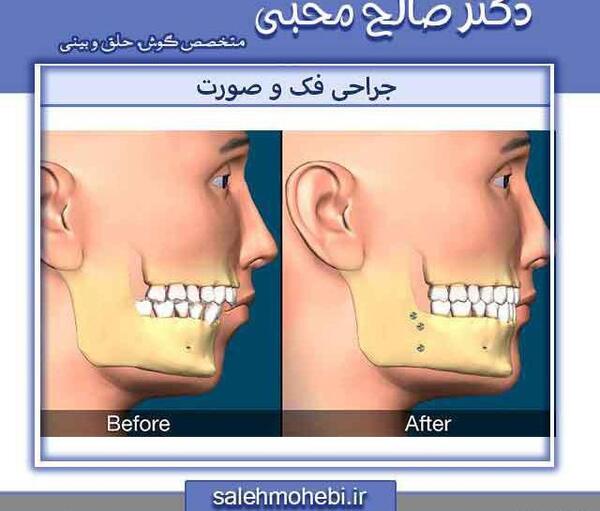 عکس قبل و بعد عمل جراحی فک