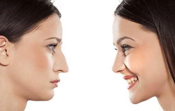 عکس قبل و بعد عمل جراحی فک