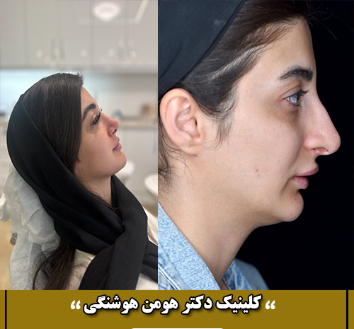 عکس قبل و بعد عمل جراحی فک