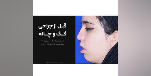 عکس قبل و بعد عمل جراحی فک