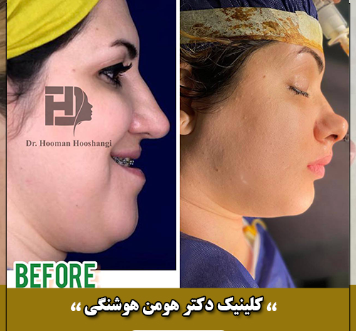 عکس قبل و بعد عمل جراحی فک