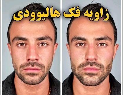 عکس قبل و بعد عمل جراحی فک