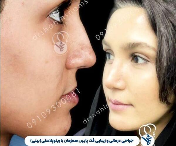 عکس قبل و بعد عمل جراحی فک
