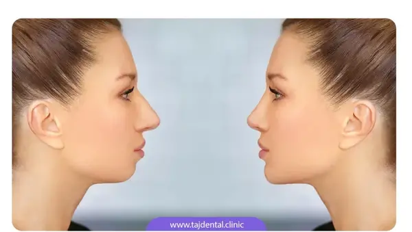 عکس قبل و بعد عمل جراحی فک