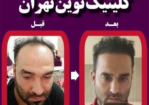 عکس های قلی زاده قبل از کاشت مو