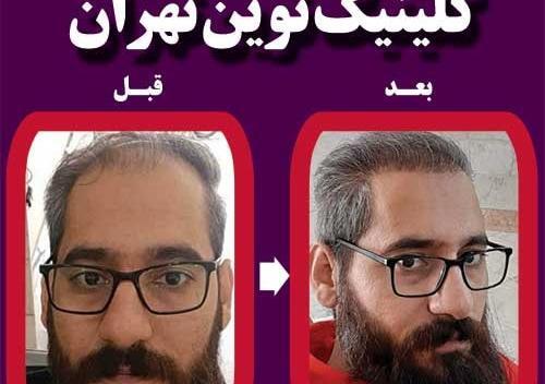 عکس های قلی زاده قبل از کاشت مو