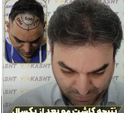 عکس های قلی زاده قبل از کاشت مو