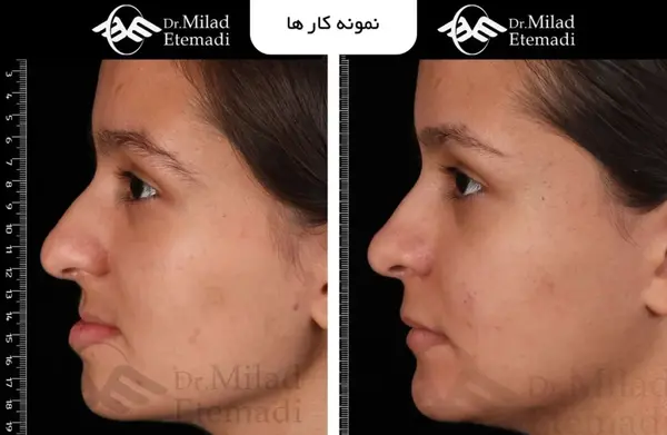 عکس های قبل و بعد جراحی فک