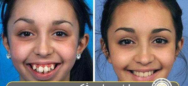 عکس های قبل و بعد جراحی فک
