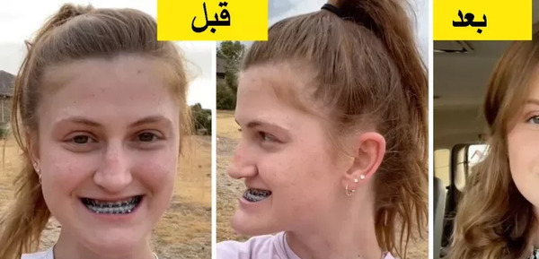 عکس های قبل و بعد جراحی فک