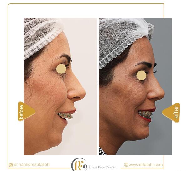 عکس های قبل و بعد جراحی فک