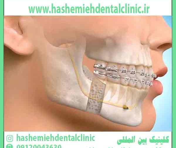 عکس های قبل و بعد جراحی فک