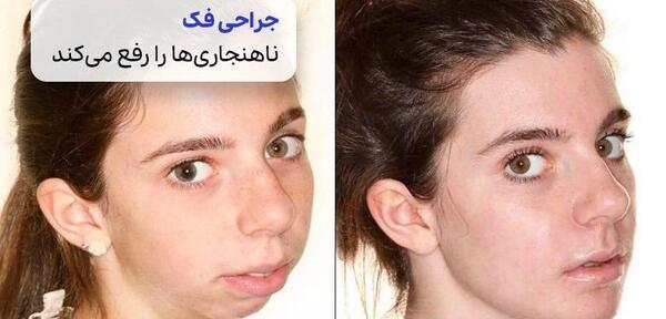 عکس های قبل و بعد جراحی فک