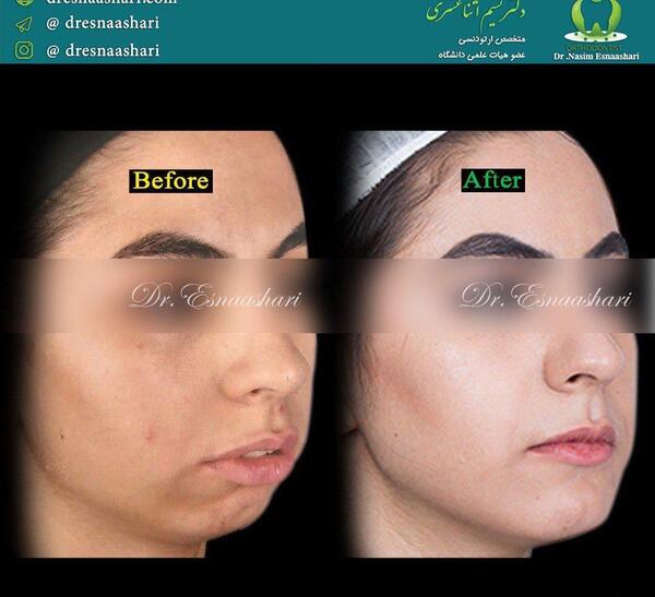 عکس های قبل و بعد جراحی فک