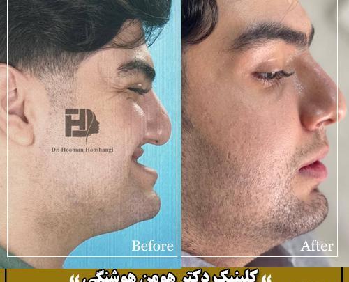 عکس های قبل و بعد جراحی فک