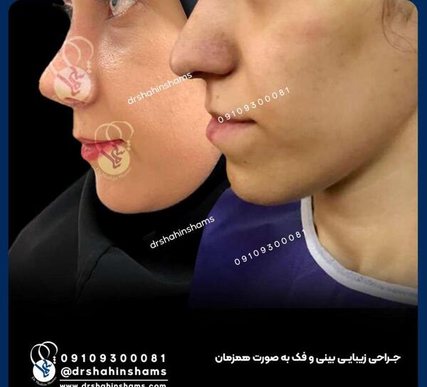 عکس های قبل و بعد جراحی فک