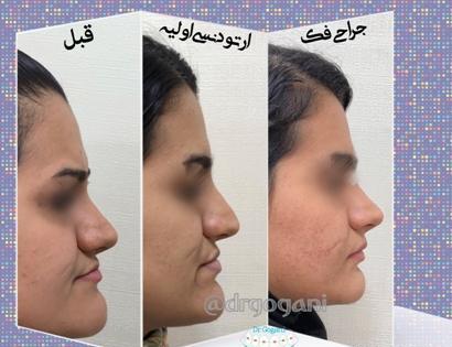 عکس های قبل و بعد از عمل جراحی فک