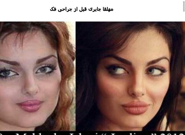 عکس های قبل و بعد از عمل جراحی فک
