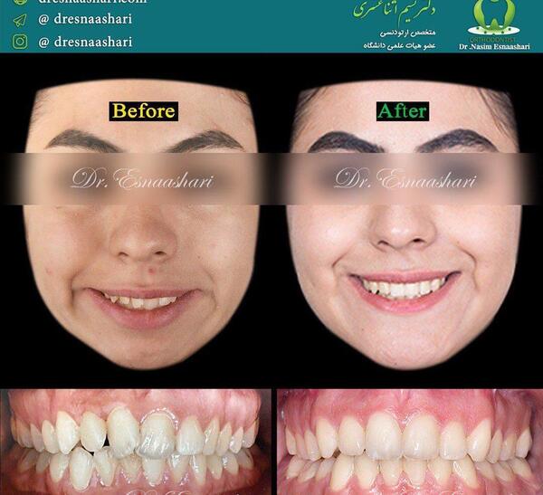 عکس های قبل و بعد از عمل جراحی فک