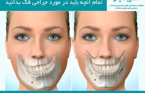 عکس های قبل و بعد از عمل جراحی فک