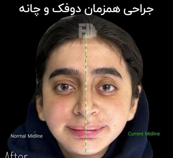 عکس های قبل و بعد از عمل جراحی فک