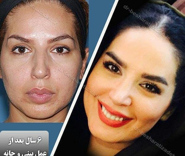 عکس های قبل و بعد از عمل جراحی فک