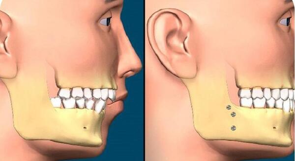 عکس های قبل و بعد از عمل جراحی فک