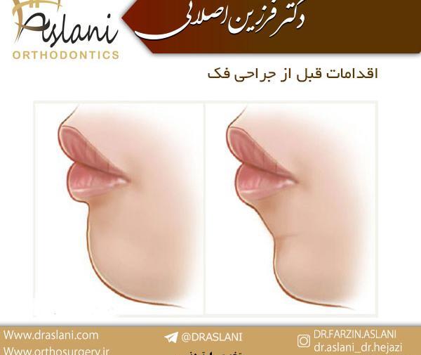 عکس های قبل و بعد از عمل جراحی فک