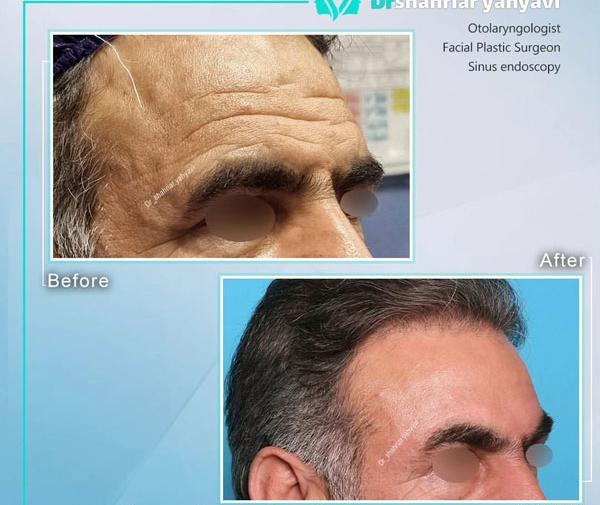عکس قبل و بعد جراحی لیفت صورت