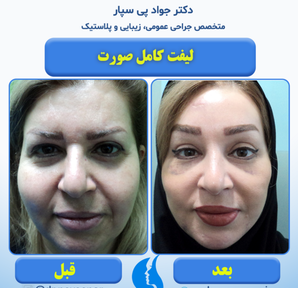 عکس قبل و بعد جراحی لیفت صورت