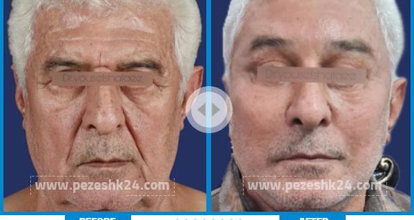 عکس قبل و بعد جراحی لیفت صورت