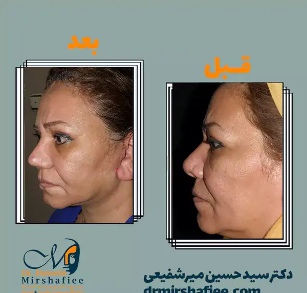 عکس قبل و بعد جراحی لیفت صورت