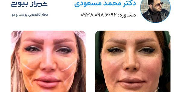 عکس قبل و بعد جراحی لیفت صورت