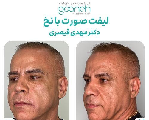 عکس قبل و بعد جراحی لیفت صورت