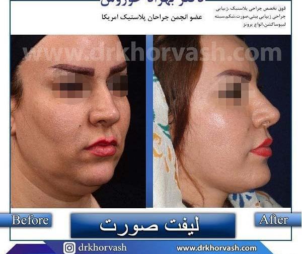 عکس قبل و بعد جراحی لیفت صورت