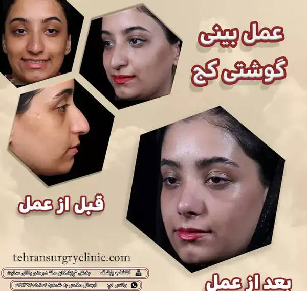 عکس قبل و بعد جراحی لیفت صورت