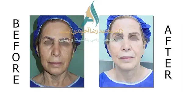 عکس قبل و بعد جراحی لیفت صورت