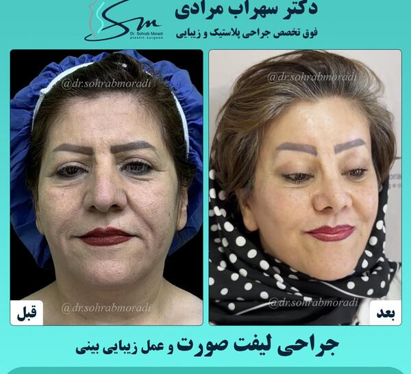 عکس قبل و بعد جراحی لیفت صورت