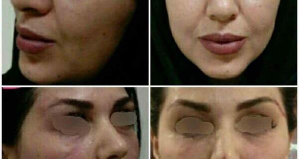 عکس قبل و بعد جراحی لیفت صورت
