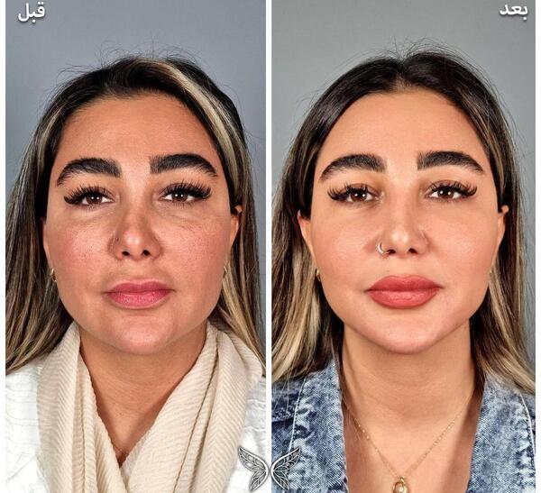عکس قبل و بعد عمل لیفت صورت