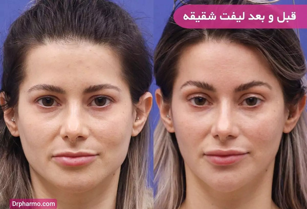 عکس قبل و بعد عمل لیفت صورت