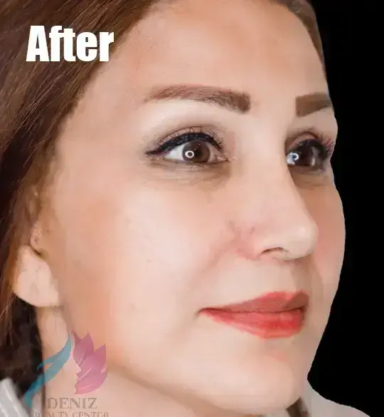 عکس قبل و بعد عمل لیفت صورت