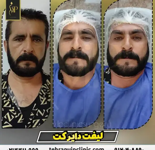 عکس قبل و بعد عمل لیفت صورت
