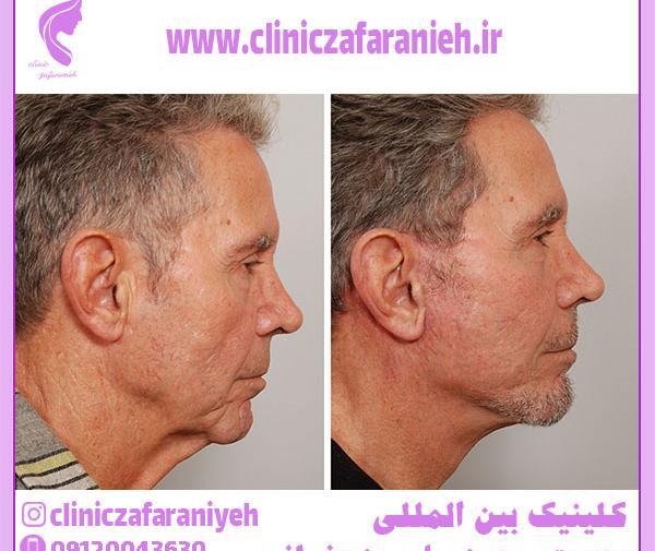 عکس قبل و بعد عمل لیفت صورت