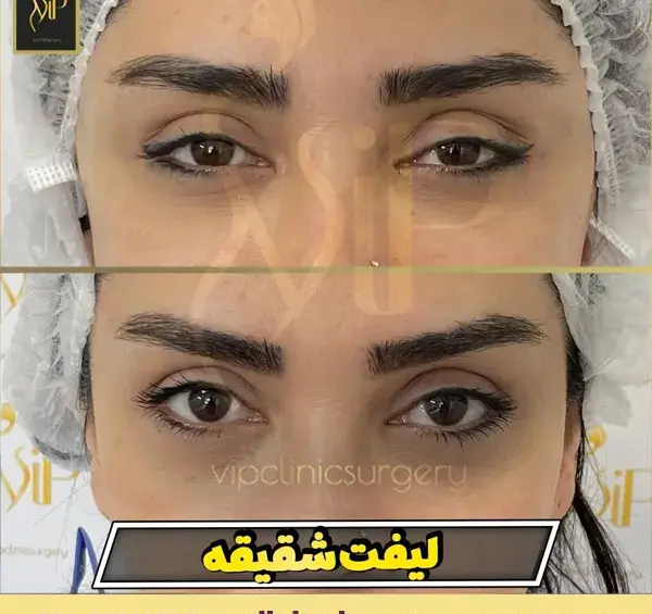 عکس قبل و بعد عمل لیفت صورت