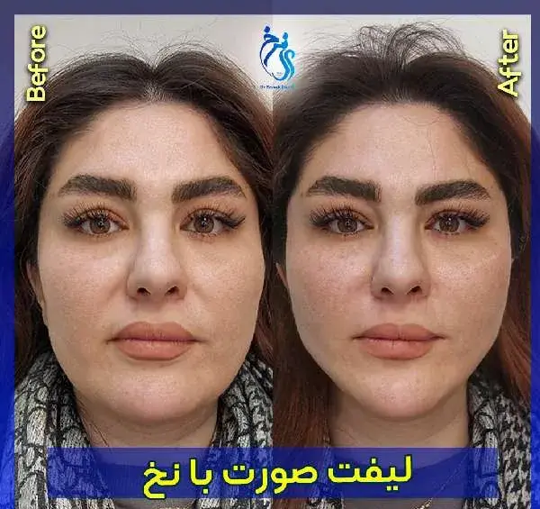 عکس قبل و بعد عمل لیفت صورت